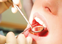 初期段階の虫歯(CO～C2)の治療