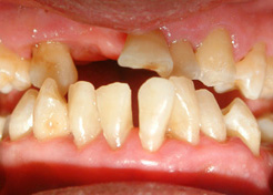 歯周病の進行具合と治療